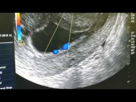 Embarazo ectÃ³pico en cicatriz de cesÃ¡rea con Tratamiento local con PreservaciÃ³n del Ãtero.