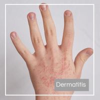 Dermatitis