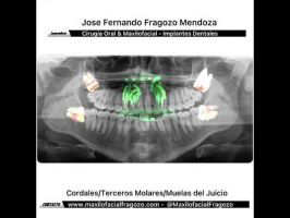 Extracción de Cordales /Terceros molares/Muelas del juicio.