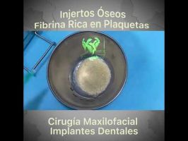 Implantes Dentales / Injertos Óseos / Fibrina Rica en Plaquetas.