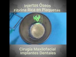Implantes Dentales / Injertos Óseos / Fibrina Rica en Plaquetas.
